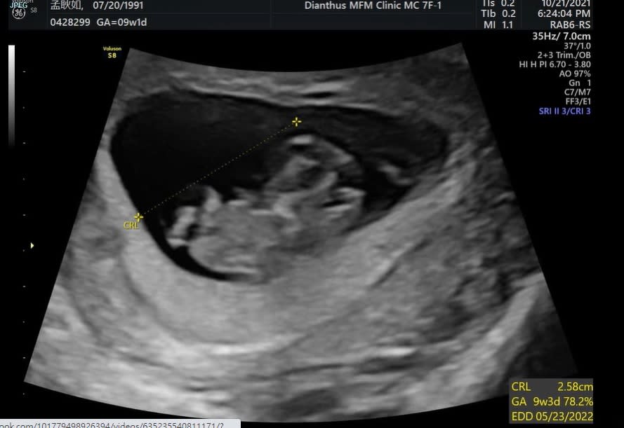 孟耿如昨（16）日在社群宣布懷孕的好消息，並曬出超音波照。（圖／翻攝自孟耿如臉書）
