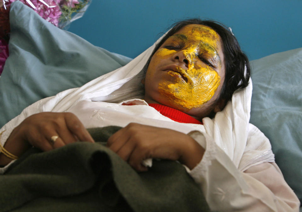 Shamsia, 17, victim of an acid attack by the Taliban, lies on a bed at a hospital in Kabul