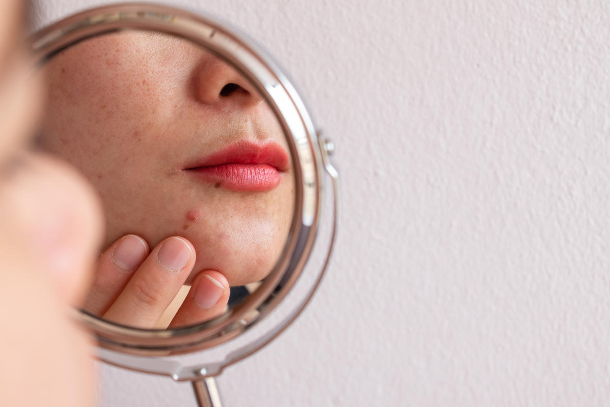 Acne has no expiration date and can happen in adulthood, not just during puberty. (Photo: Getty Images)