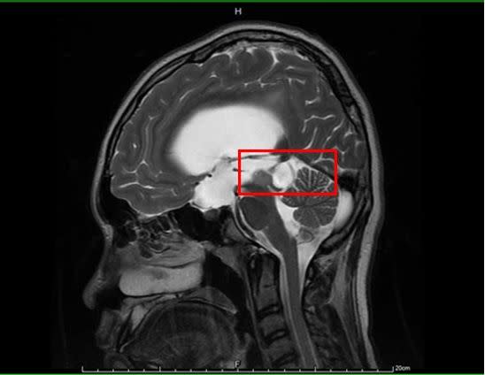 ▲男孩從國小四年級開始頭痛到國三，最後暈倒送醫才發現竟腦部竟長腫瘤（紅圈處為中腦腫瘤）。（圖由台大新竹分院提供）