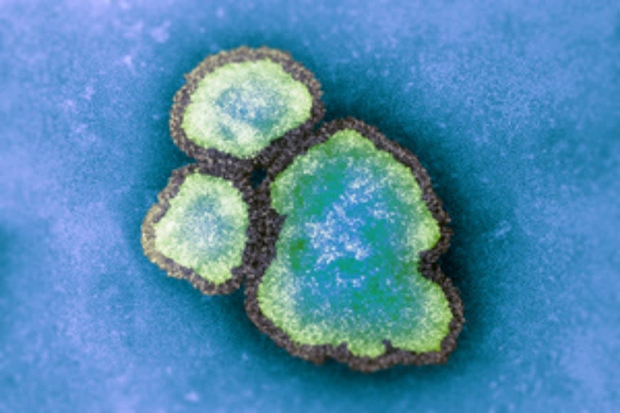 A colourized electron transmission micrograph of measles virus particles is pictured here. Durham Region Public Health said it confirmed its first case of measles in the region, in an adult who was travelling and is now recovering at home. (CBC, UK Health Security Agency - image credit)