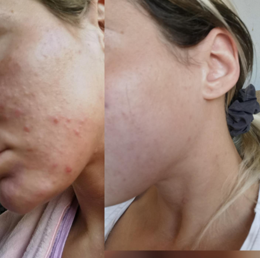 A woman shoes her face in three-quarter profile with before-and-after shots of her skin after using the soap. It is smoother and has less blemishes.