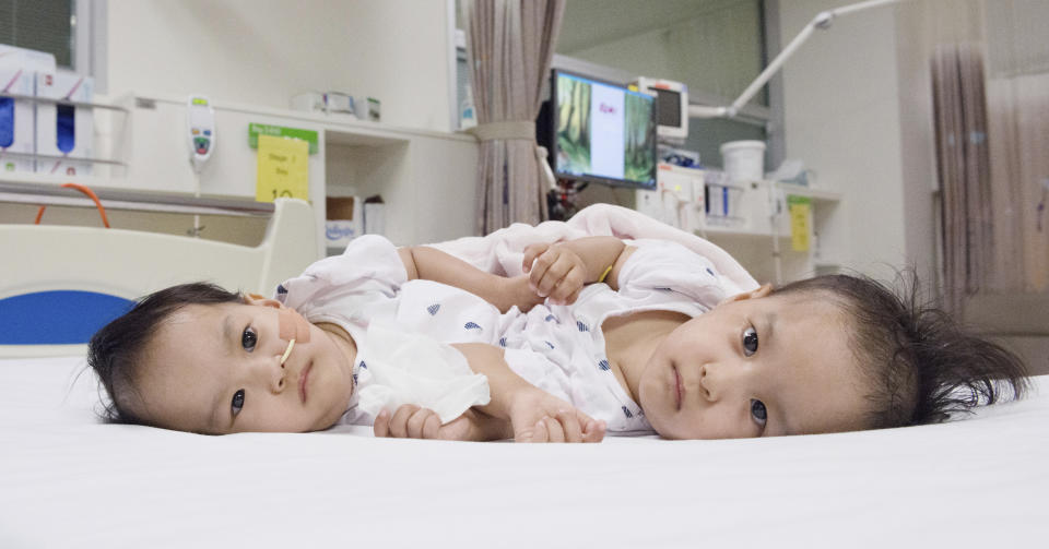 This photo provided by RCH Melbourne Creative Studio, shows the 15-month-old girls before surgery at the Royal Children's Hospital Melbourne, Australia Friday, Nov. 9, 2018. Surgeons in Australia have begun separating the conjoined twins from Bhutan in a delicate operation expected to last most of the day. (RCH Melbourne Creative Studio via AP)