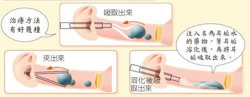 耳垢栓塞,耳鳴