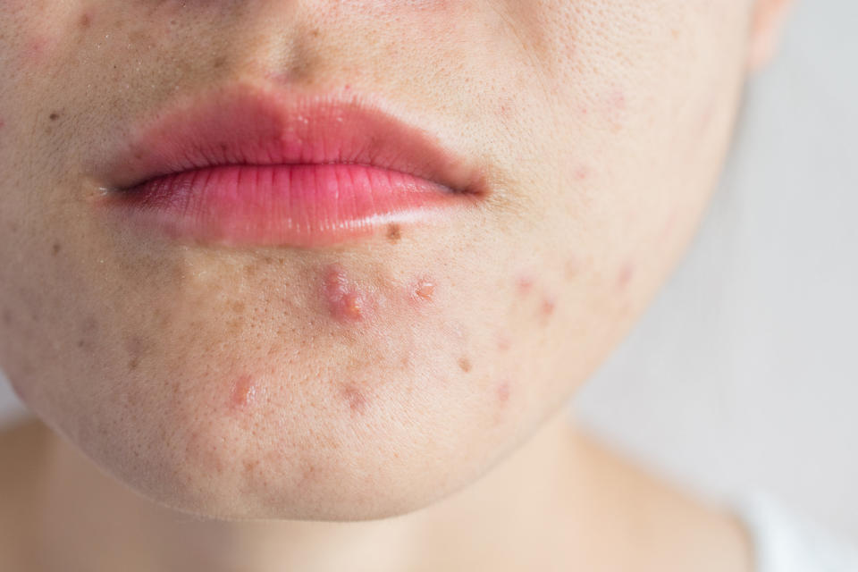 close up of a pimple on someone's chin