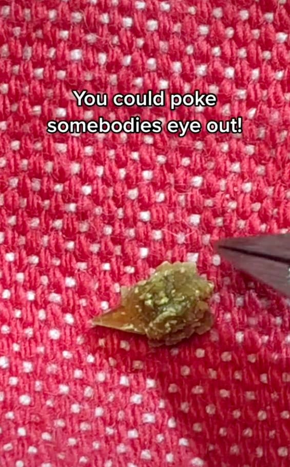 A closeup of the kidney stone with the caption "You could poke somebodies eye out!"