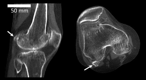 Fabella: Bone thought to be lost to evolution mysteriously returning to human body