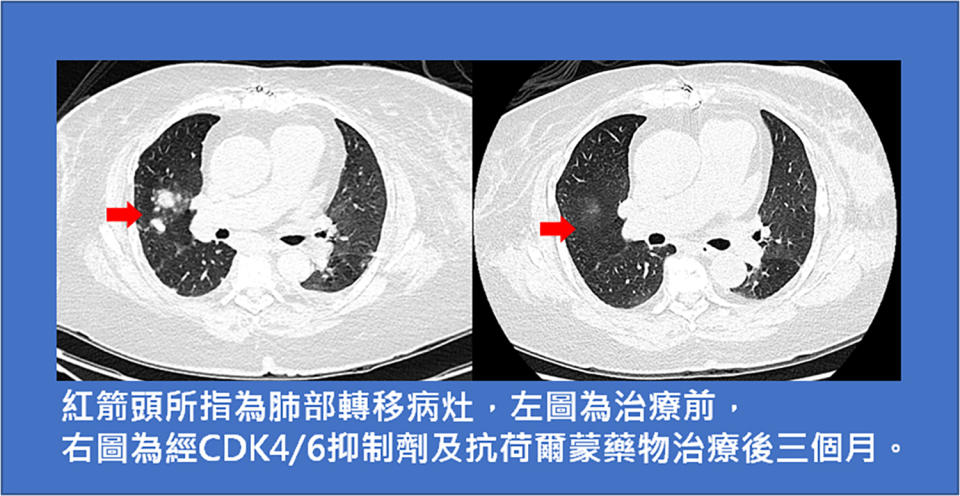 台東馬偕蔡承志醫師表示末期乳癌仍可靠新型標靶藥物獲控制。