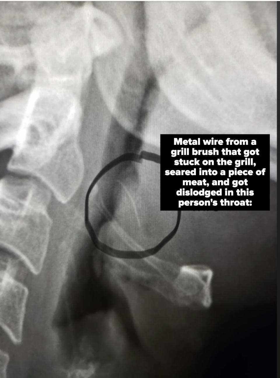 X-ray image showing a metal wire inside the neck area, circled and labeled "Metallic wire."