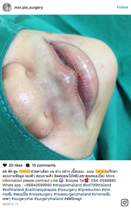 Lip reduction surgery, which involves cutting the lips to reduce their size, is attracting attention on social media.