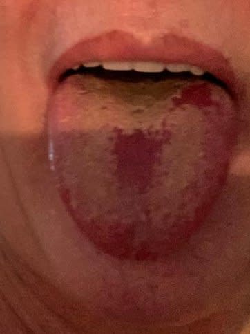 An example of 'COVID tongue' - an increasingly common symptom of coronavirus sufferers (Twitter/Tim Spector)