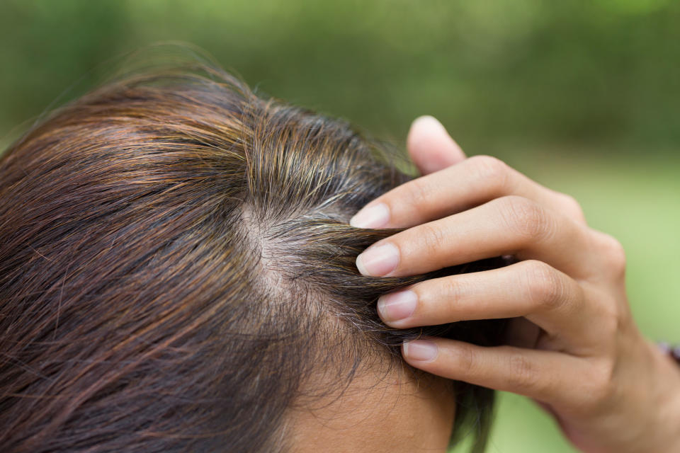 Am Haaransatz zeigen sich die grauen Haare meist als erstes. (Bild. Getty Images)