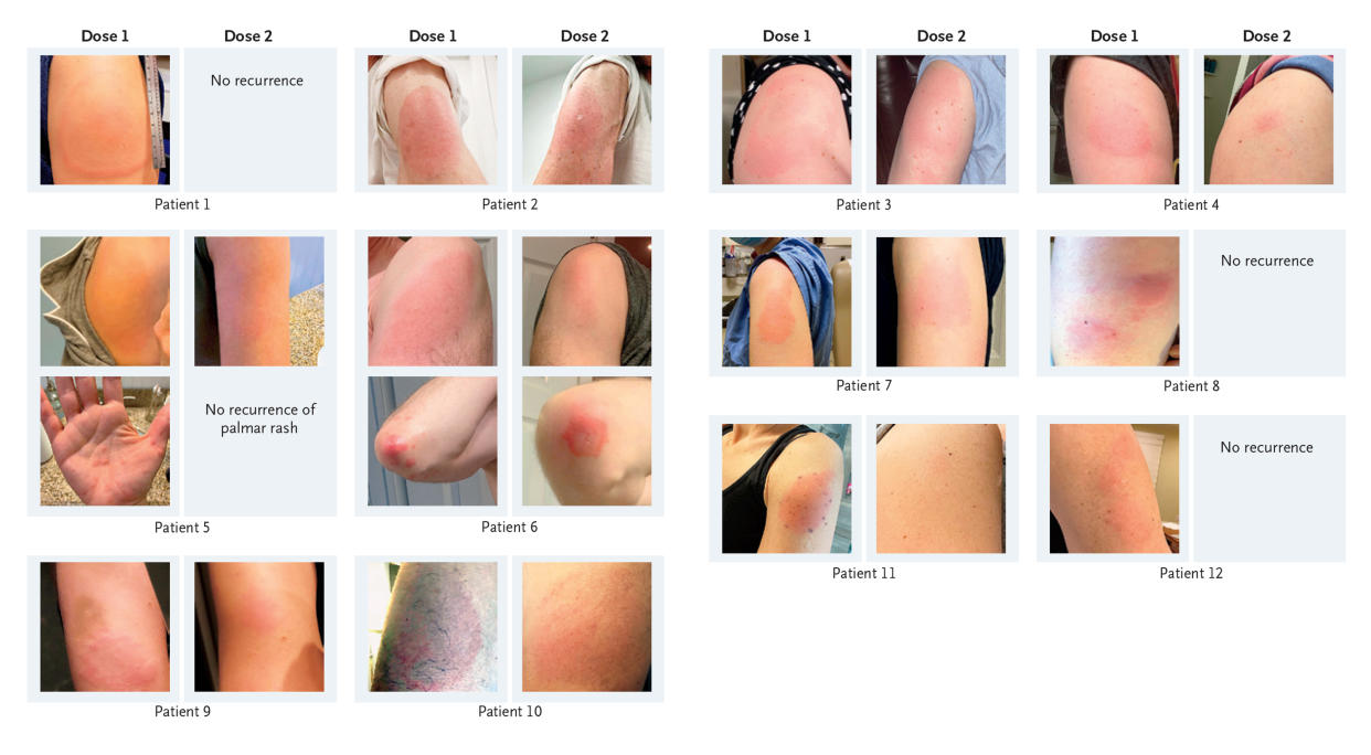 Una serie de fotografías integradas en una sola imagen, proporcionada por la revista New England Journal of Medicine, muestra reacciones retardadas de la piel en diversos pacientes tras recibir las vacunas de ARNm contra el COVID-19. (New England Journal of Medicine vía The New York Times)
