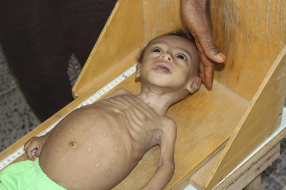 In this Sunday, June 14, 2020 photo, seven-month-old Issa Ibrahim Nasser is measured at a clinic in Deir Al-Hassi, At seven months old, Issa weighs only three kilos. Like him, hundreds of children suffer from acute severe malnutrition because of poverty and grinding conflict. Yemen. (AP Photo/Issa Al-Rajhi)