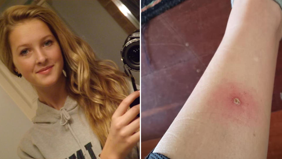 Canadian backpacker Alyssa Cassidy (left) shared photos of an apparent spider bite, pictured right.