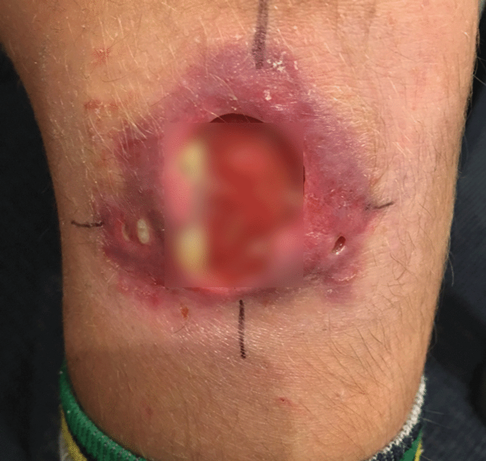 Burili ulcer is also known as the Daintree ulcer. This case was from a Victorian patient in April. Photo: AAP