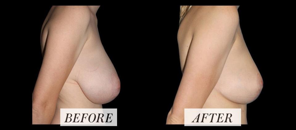 <h1 class="title">Life in Plastic: Breast Reduction Surgery Before-and-After Images.jpg</h1><cite class="credit">Courtesy of Rukmini Rednam</cite>