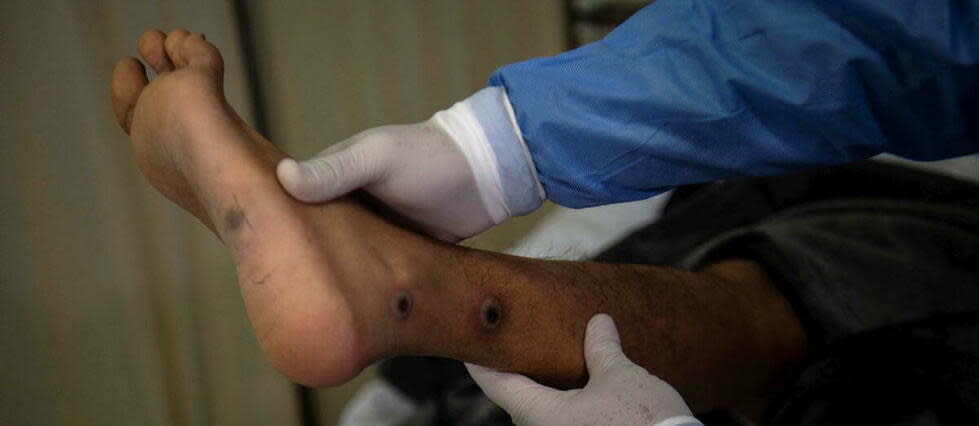 Lésions causées par la variole du singe.  - Credit:ERNESTO BENAVIDES / AFP