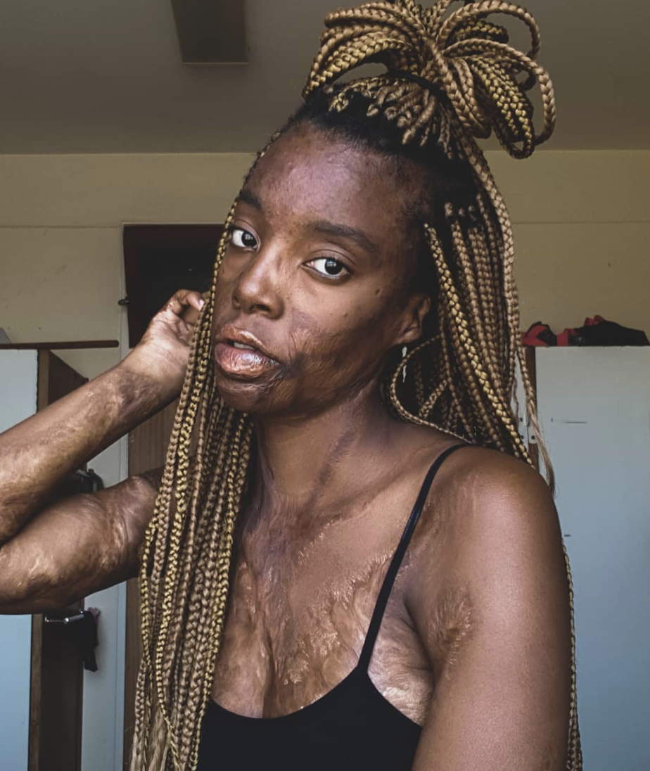 Karabo Tebedi shared a deeply personal moment on Twitter where she decided to embrace her scars. (Photo: Karabo Tebedi)