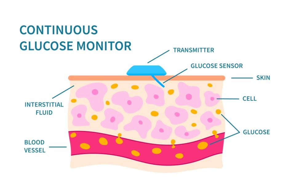 Illustration of a continuous glucose (sugar) monitor (CGM) attached to a patient's skin. This device measures the levels of glucose in the interstitial fluid (the fluid around the cells), rather than in the blood. Diabetics have to measure their blood glucose levels regularly. A CGM can provide measurements, which are transmitted wirelessly, as often as once per minute without the need for a finger prick. For a version of this image without labels see F037/3467