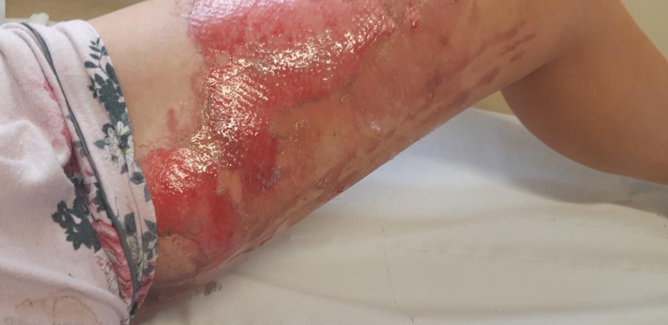 Pictured is the 28-year-old's leg with burns seen to most of her thigh.