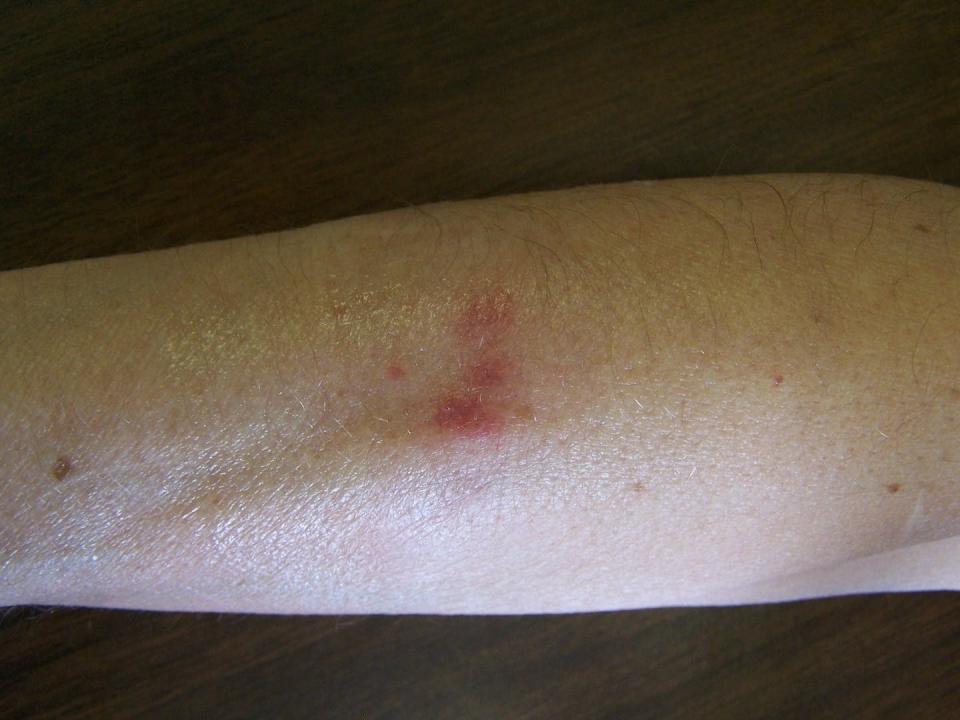 The marks from bed bug bites can persist on human skin for several days. Jerome Goddard and Kristine T. Edwards