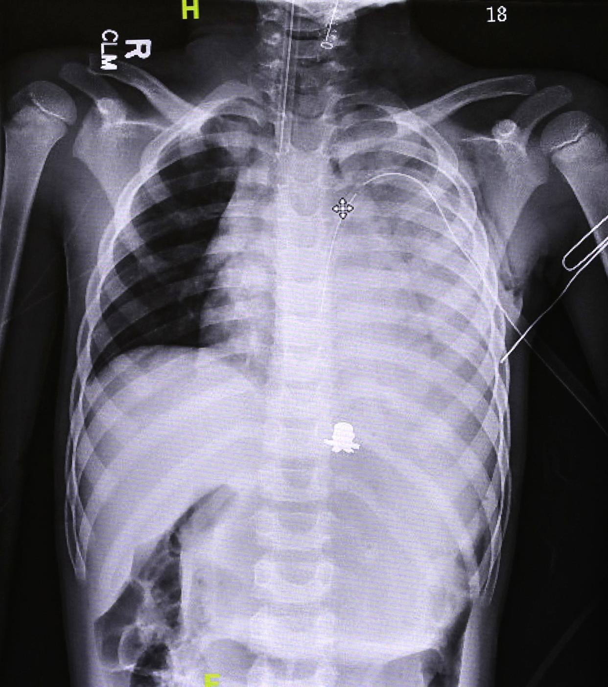 This X-ray image of Tyren Thompson, 7, shows where a bullet lodged in his chest when he was shot last month after a pee wee football game in Akron.