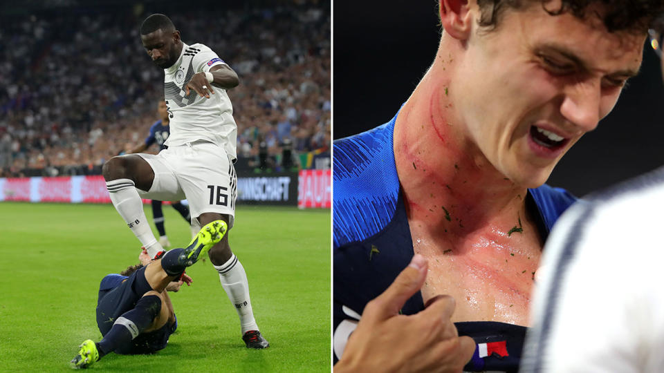 Pavard bares scars after a nasty challenge. Pic: Getty