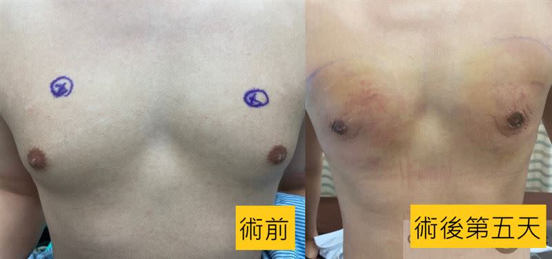 「男性女乳症」經過手術重塑後，成功地讓胸部外觀恢復自然平坦，更重要的是讓他們重拾自信。（圖／長安醫院提供）