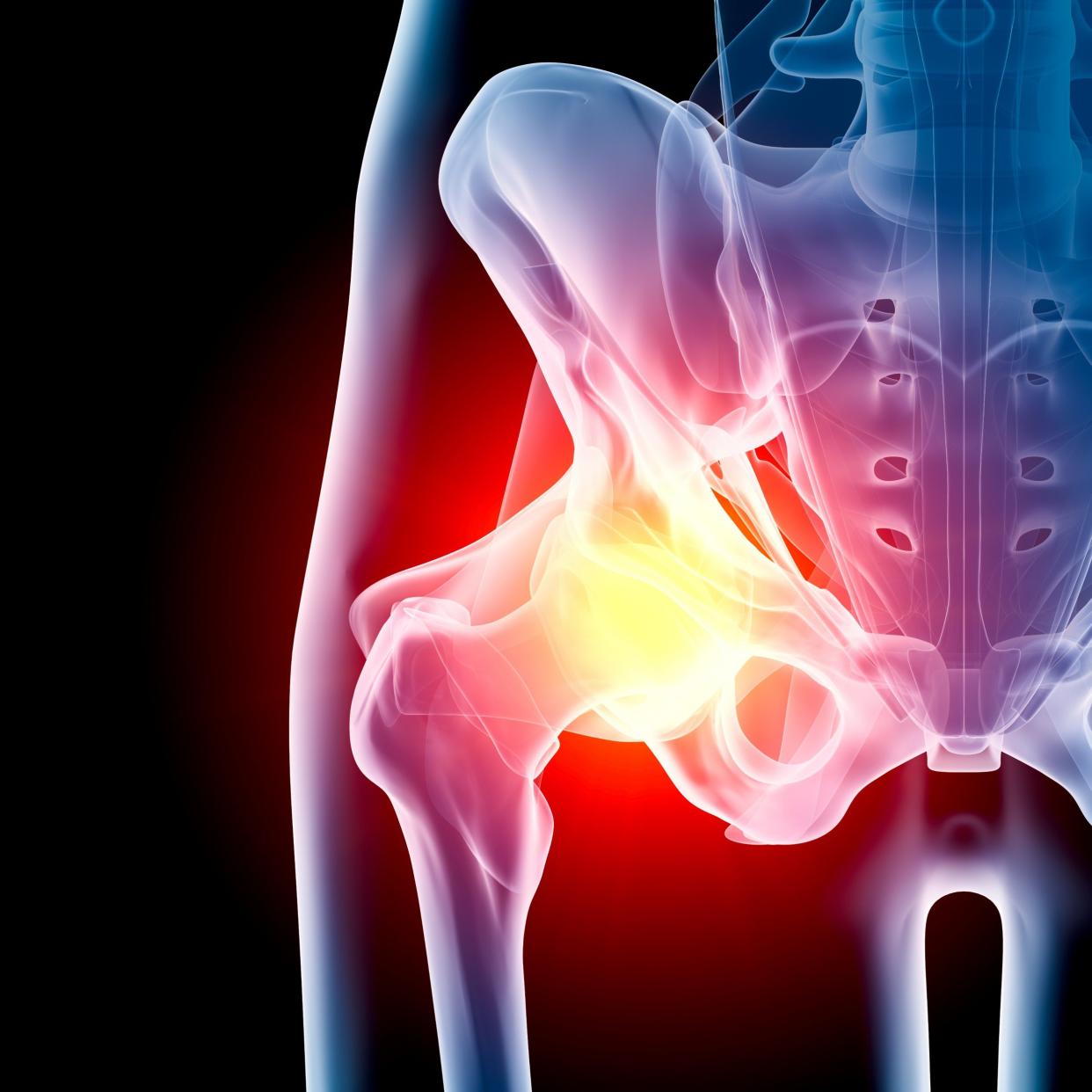 Hip replacement surgery is one of the most common procedures carried out by the NHS  - Getty Images Contributor