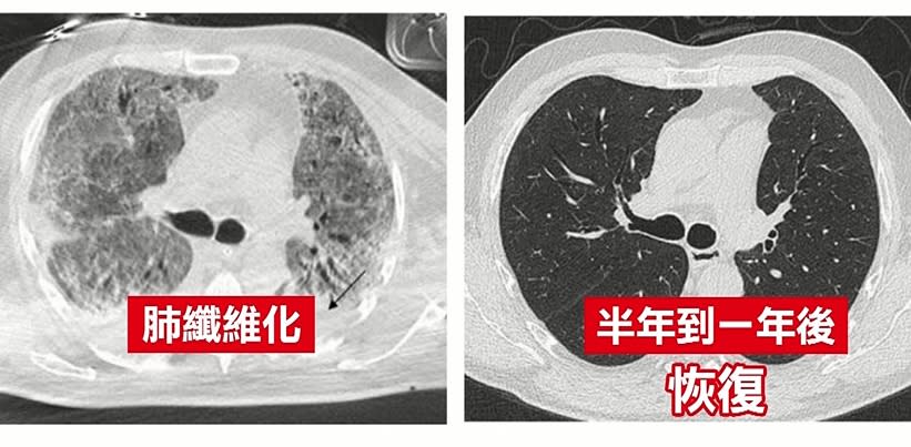 肺纖維化需要半年到一年時間才能恢復。（圖／東森新聞）