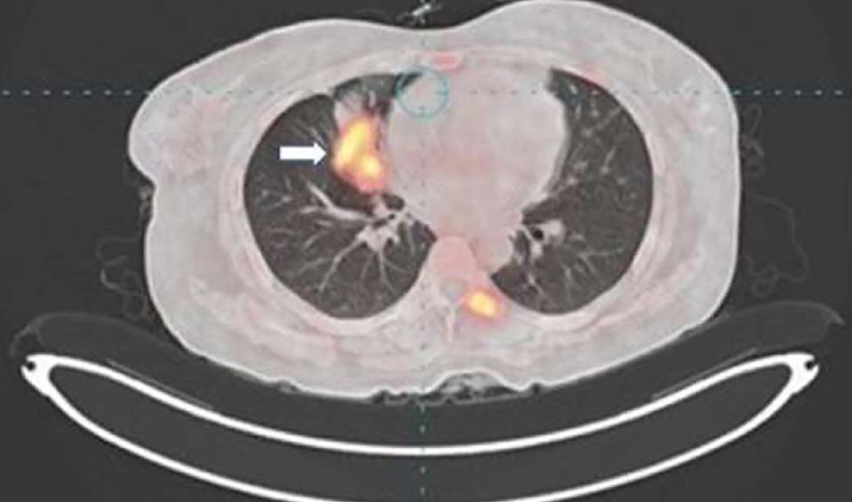 The doctor said the patient had no other symptoms of lung cancer. Singh et al/ScienceDeirect