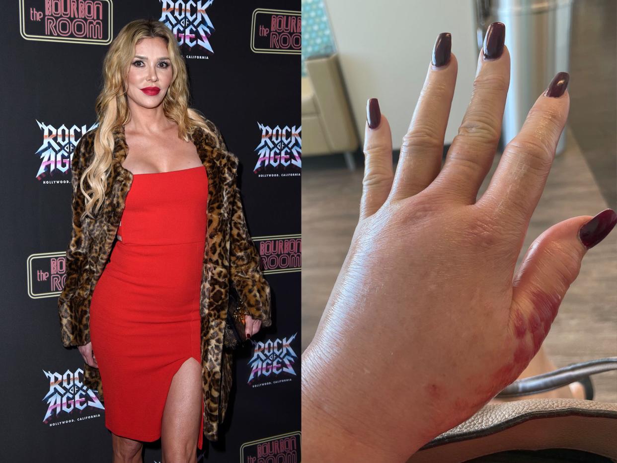 composite of Brandi Glanville and her spider bite