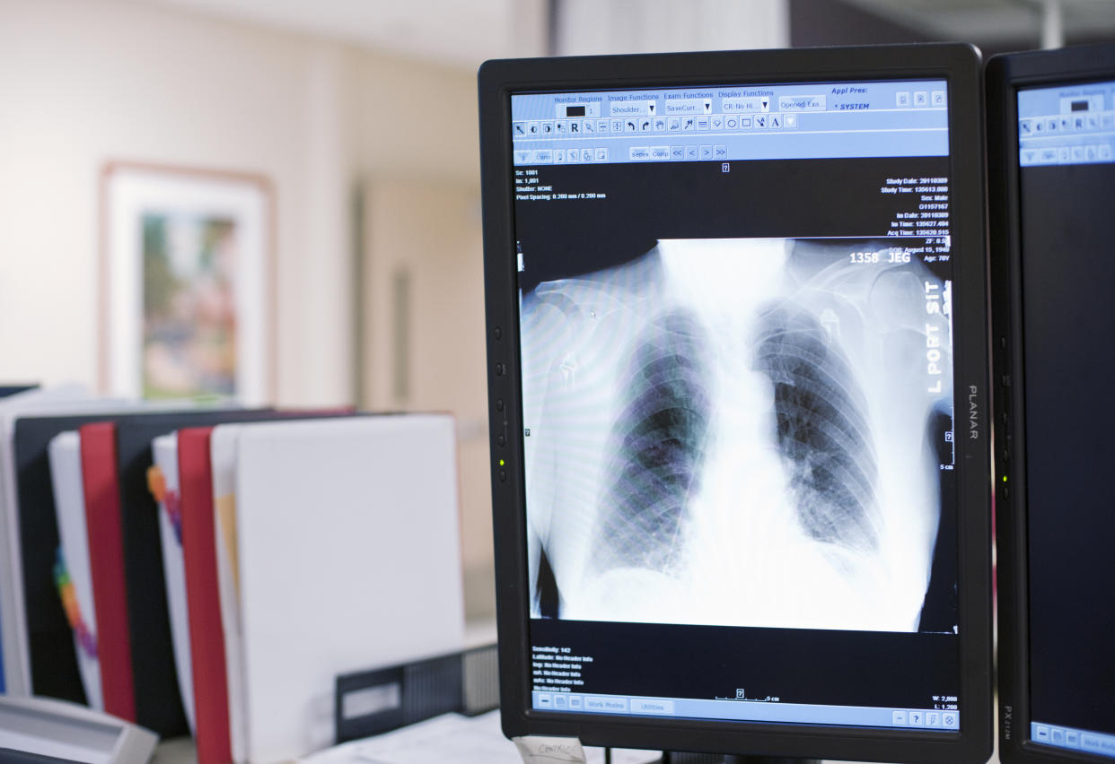 AI can help doctors analyse chest X-Rays. (Getty)
