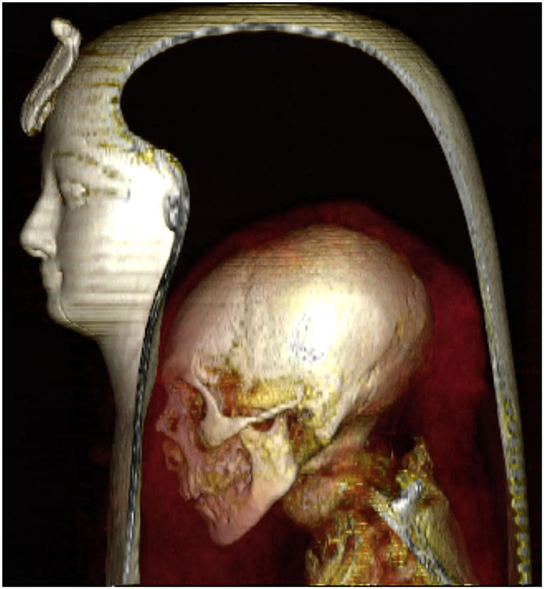 CT image of the head of the wrapped mummy of Amenhotep I reveals the component layers: the mask, the head of the mummy, and the surrounding bandages. / Credit: Sahar N. Saleem, Zahi Hawass / Frontiers in Medicine