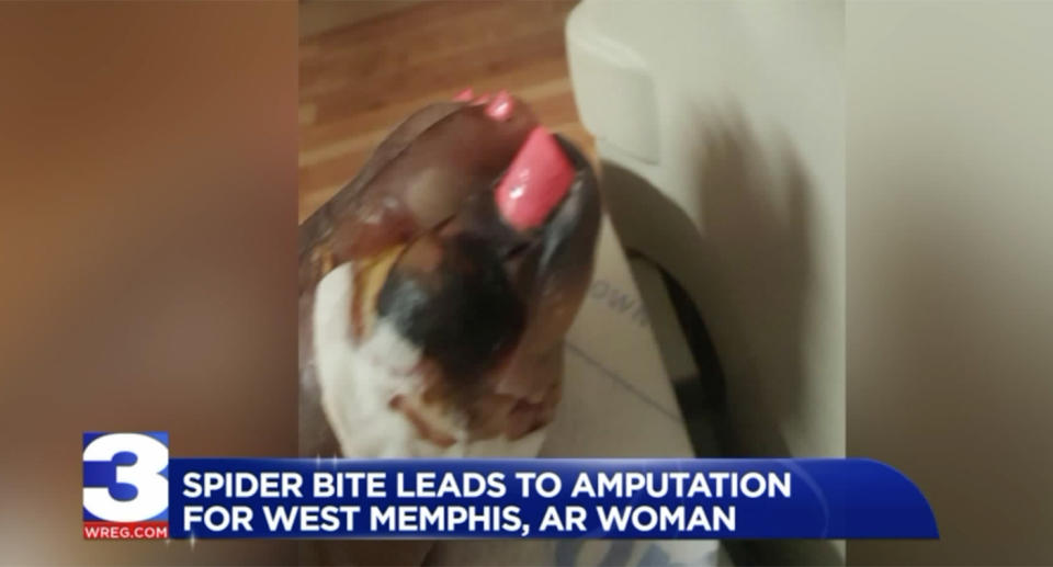 A spider bite led to a leg amputation after a woman’s toe went black. Source: WREG Memphis News Channel 3