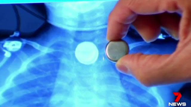 <span>If swallowed, a button battery can get stuck in a child’s throat and cause a chemical reaction that burns through tissue causing catastrophic bleeding</span>. Source: 7 News