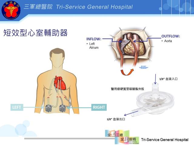 急性心臟衰竭死亡率逾9 成短效型心室輔助器成病患「救心」