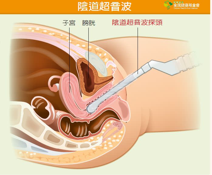 陰道超音波示意圖