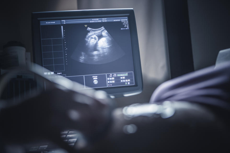 Ultrasound screen showing a fetus with a healthcare professional's hand in the foreground