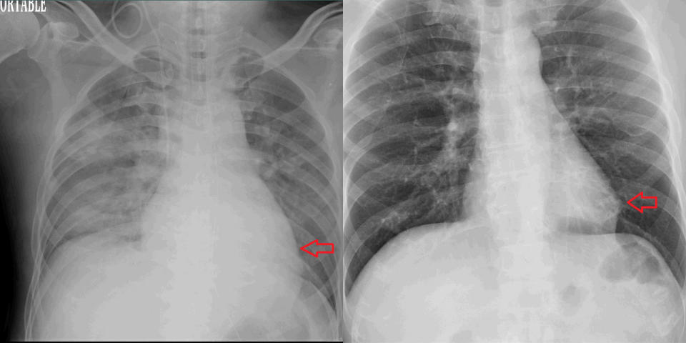 治療前(左)心臟因發炎導致急性衰竭而肥大，併雙側肺水腫；治療後(右)心臟已縮小，兩側肺已無積水情形。