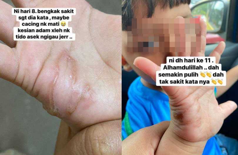 男童在玩沙時被蟲鑽入手掌，所幸治療後蟲子已死。（圖／翻攝自Munni Hasan II臉書）