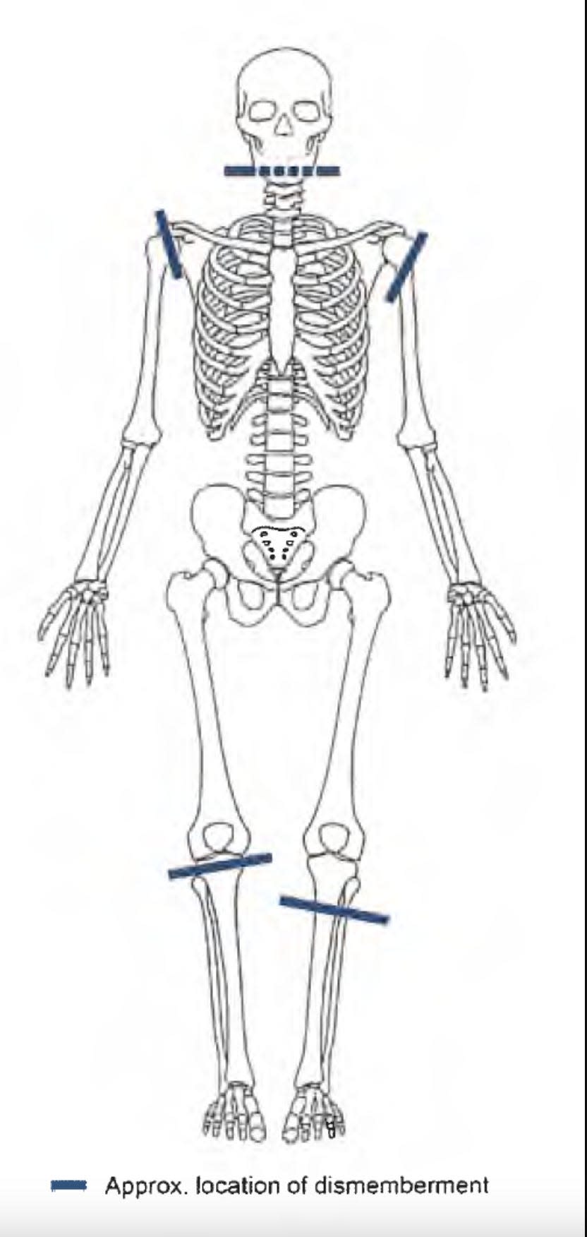 A diagram of a skeleton with lines at the neck, shoulders, and knees showing the approximate location of dismemberment.
