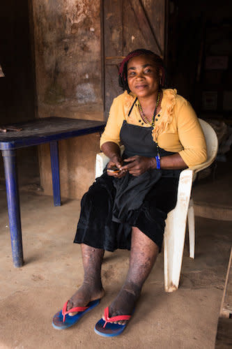 Ndidi Ekeanyawu's swollen legs are covered in cuts from the traditional healer. (Photo: The Carter Center / R McDowell)