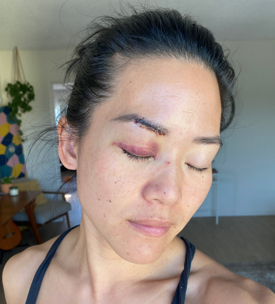 Michelle Yi says she was beaten over the head with a metal bar (Twitter.com/MurtzJaffer)