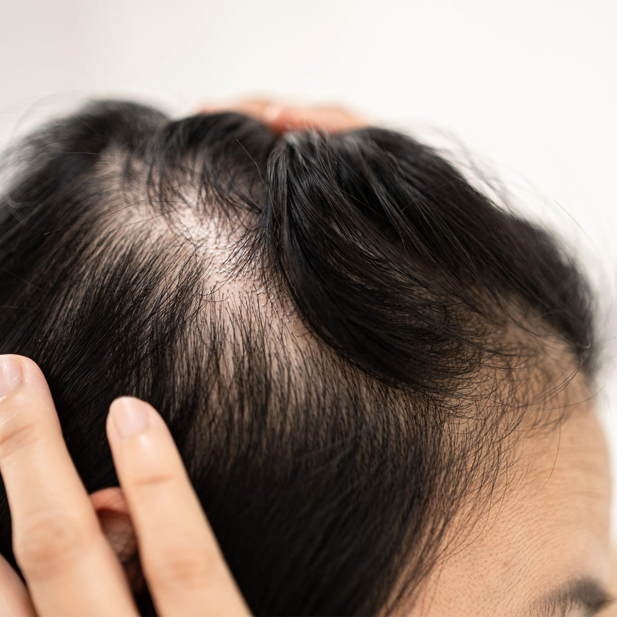 womens-scalp-bald-spots
