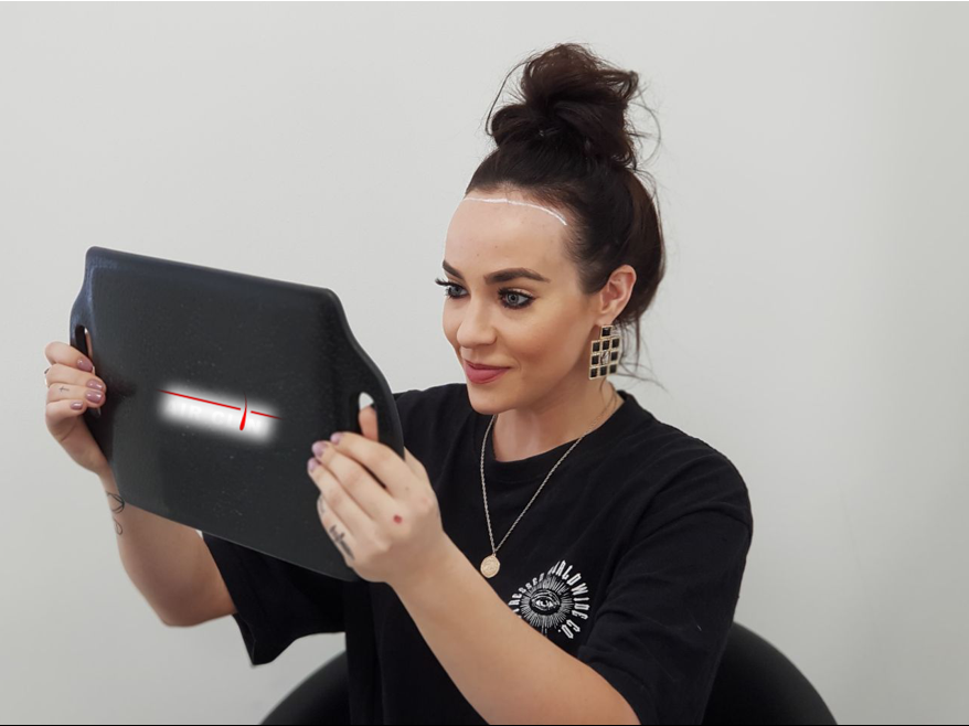 Stephanie Davis underwent a hair transplant. [Photo: British Hair Clinic]