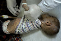 An acute malnourished boy is treated at the Indira Gandhi hospital in Kabul, Afghanistan, Sunday, May 22, 2022. Some 1.1 million Afghan children under the age of five will face malnutrition by the end of the year. , as hospitals wards are already packed with sick children . (AP Photo/Ebrahim Noroozi)