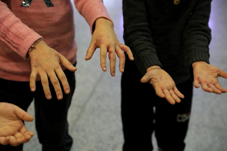 Children of the Iraqi migrants show hands with wounds and infections to the members of the media as they arrive to the airport in Irbil, Iraq, early Friday, Nov. 26, 2021. A second group of Iraqis have returned home in repatriation flights after a failed bid to enter Europe. Over 170 people returned on a flight that landed in Irbil airport in the northern Kurdish-run region Friday morning. (AP Photo/Hussein Ibrahim)