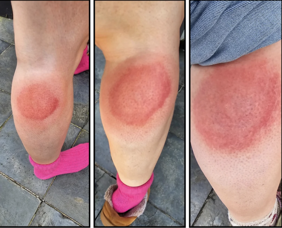 Three side-by-side images showing close-ups of a swollen, red rash on a person's knees. The rash appears to be irritated or inflamed